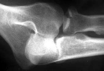 probleme cu cotul deformarea osteoartrozei articulațiilor mici ale tratamentului picioarelor