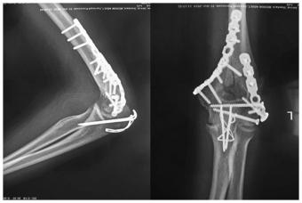 fractura articulațiilor după fractura încheieturii)