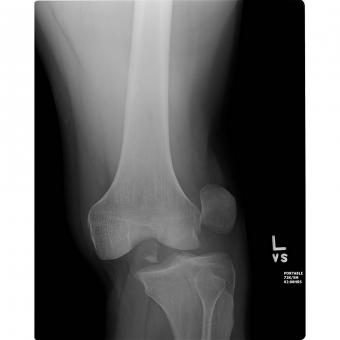consecința unei leziuni la genunchi tratamentul artritei degetelor mari