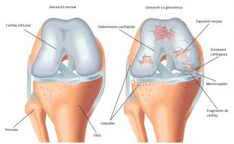 durere în articulația genunchiului cu o creștere