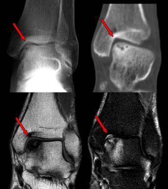 mecanismul leziunii gleznei schema de tratament pentru artroza piciorului
