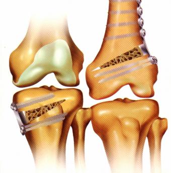 artroza femurală a genunchiului