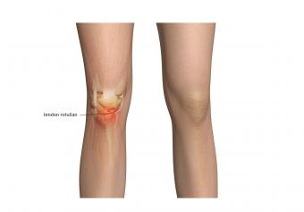 consecința unei leziuni la genunchi tratamentul inflamației articulațiilor la încheietura mâinii